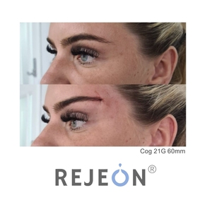 D 2025 Hot Sales Hilo Fios Cat Eye Lift 19g 60mm 100mm <strong>PDO</strong> PCL <strong>Cog</strong> <strong>Threads</strong> 21g 23g for Tightening for Beauty Center - Product Image 1