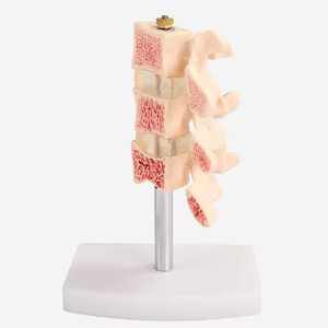 SCIEDU 2 Teile Osteoporose Läsion modell Wirbelsäulen-und Zervix dissektion gelenk modell Menschliche Anatomie Lendenwirbel modell - Product Image 3