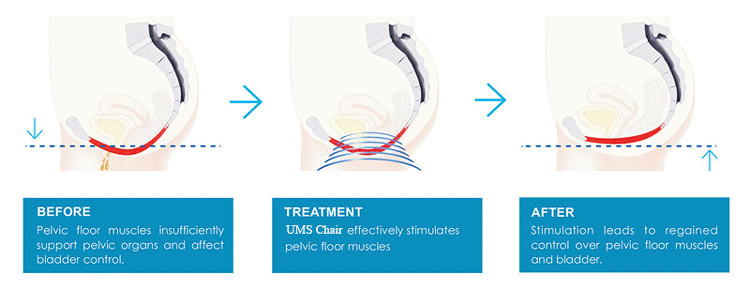 Стимулятор мышцы тренера 50hz пузыря прибора мочевыделительного Incontinence EMS прямой кишки поднимаясь тазобедренный влагалищный 1