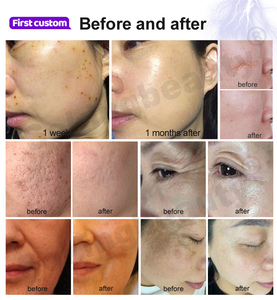 New <strong>Design</strong> <strong>Output</strong> Power 100w Derma Plasma Restore Skin Balance 6 in 1 Hot and Cold Plasma Machine - Product Image 3