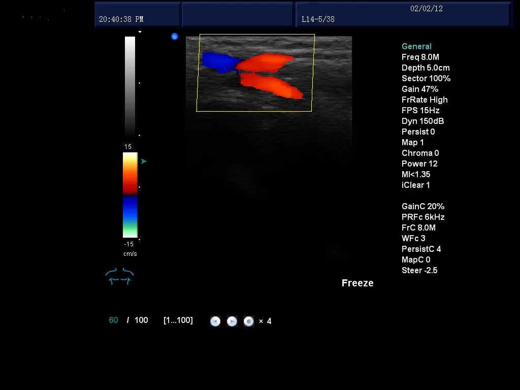 Dizüstü bilgisayar ekokardiyografi renkli doppler ultrason makinesi kardiyoloji kardiyak prob ile
