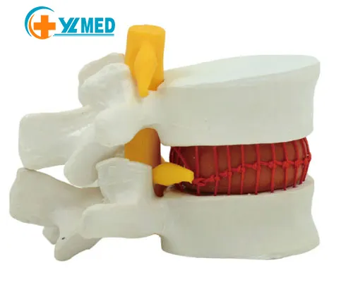 Modelo espinha humana osso espinhal disco lombar molde Corpo vertebral modelo protrusão compressão osso patológico ensino AIDS