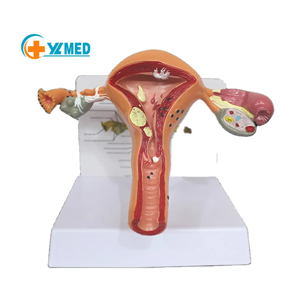 Tıp bilimi İnsan anatomisi modeli kadın üreme uterus yumurtalık patolojik değişim bilim eğitim yardımları