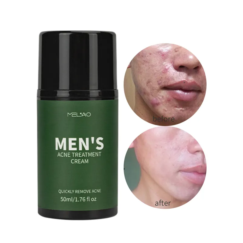 Private Label Man Acne Face Cream Lotion Mannen Acne Cream Puistje Verwijderen