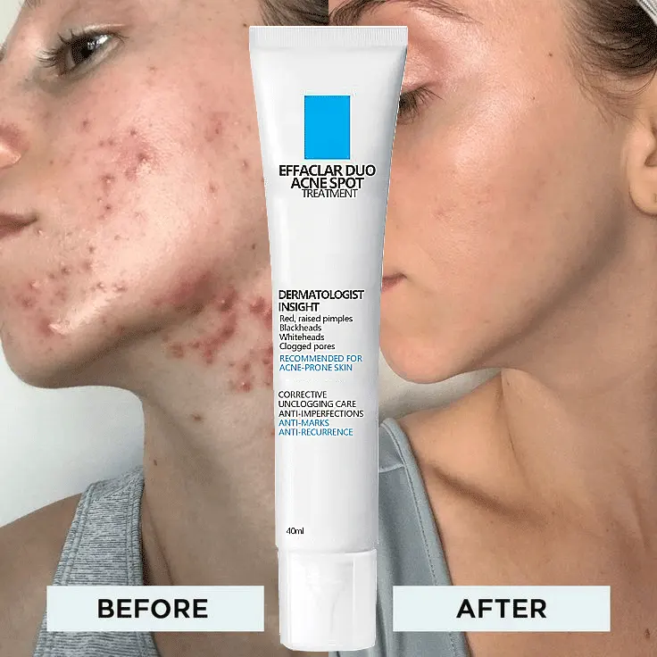 Acne Spot Behandeling Crème Met Benzoylperoxide Acne Behandeling, Smet Veilig Voor Gevoelige Gezichtshuid Anti Acne Gezichtscrème