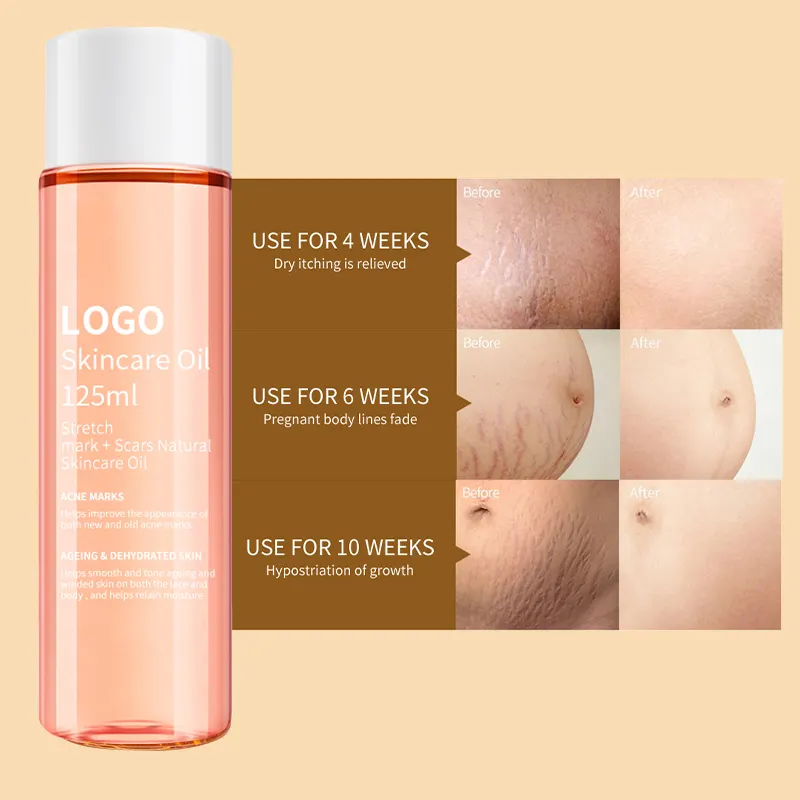 Private Label Natural Organic Moist urizing Regenerate Oil Verhindern Sie Mark Stretch Marks Regenerieren Sie Öl