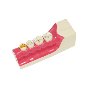 Răng Miệng dưới bên phải và tổn thương sâu răng ZM1049-11 mở rộng smt023 - Product Image 2