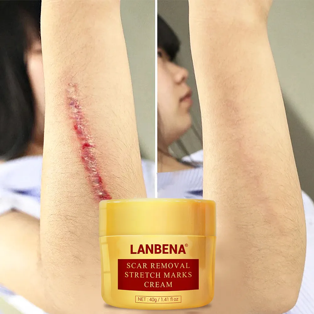 Lanbena-Crema para eliminar cicatrices de acné, crema para reparación de la piel, 40g