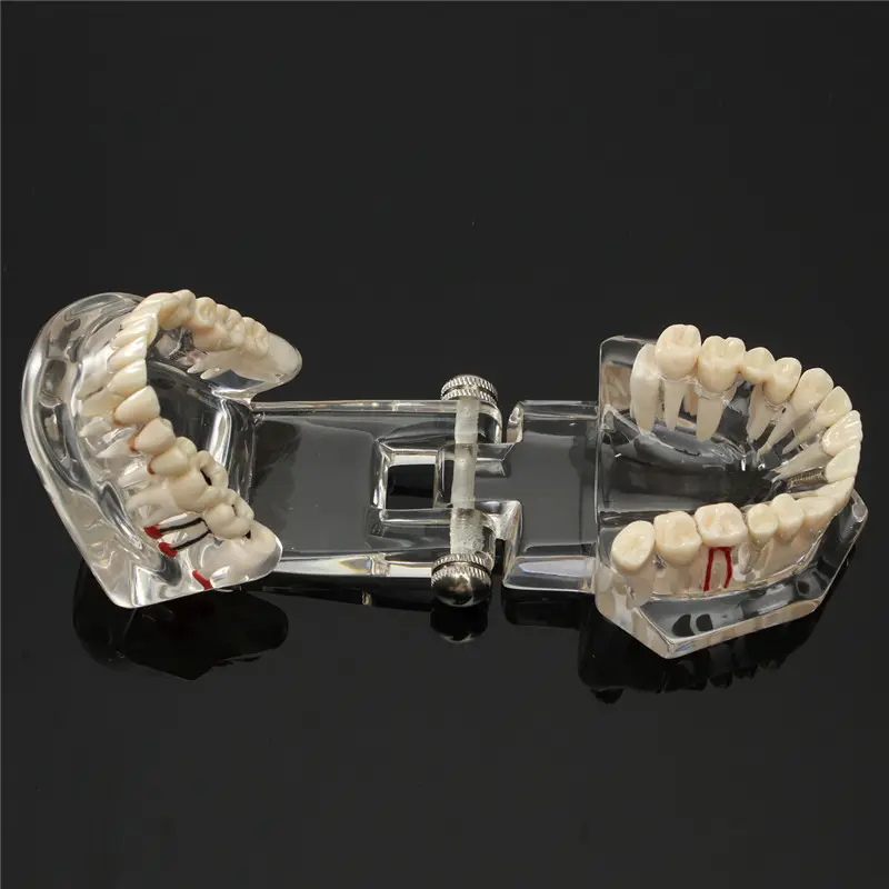 Modelo de boca para odontologia, modelo de dentes, doença dentária, com ponte, restauração, malocclusão, modelo ortodôntico para pesquisa científica dental