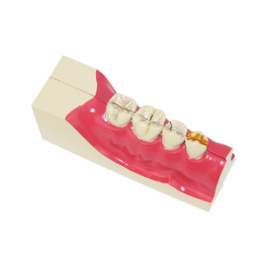 Răng Miệng dưới bên phải và tổn thương sâu răng ZM1049-11 mở rộng smt023 - Product Image 1