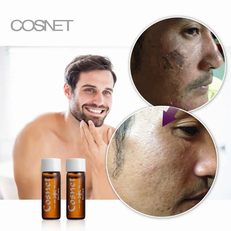 Gesichts narben entfernung Haut peeling Serum AHA Milchsäure