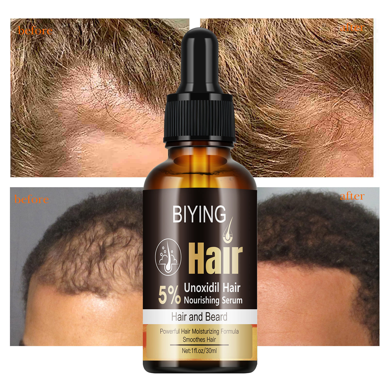 https://s.alicdn.com/%40sc04/kf/He585a61df2b84758ac6652cbc0c389aaU/Professional-5-Unoxidil-Hair-Care-Serum-Clinically-Tested-Hair-Loss-Solution-for-Thinning-Hair.jpg
