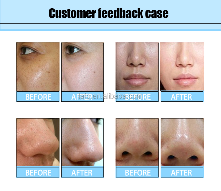 96% Oxygen purity! LF-826B hydrogen aqua water dermabrasion oxygen facial skin rejuvenation machine with oxygen mask
