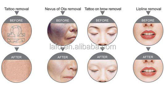 NEW design! 4 in 1 opt IPL+ 808nm diode laser + rf +nd yag laser beauty salon equipment ipl laser hair removal machine