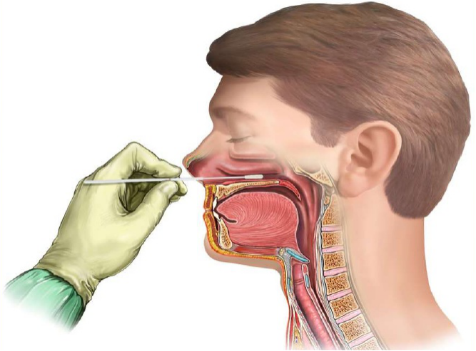 Nasopharyngeal swab sampling