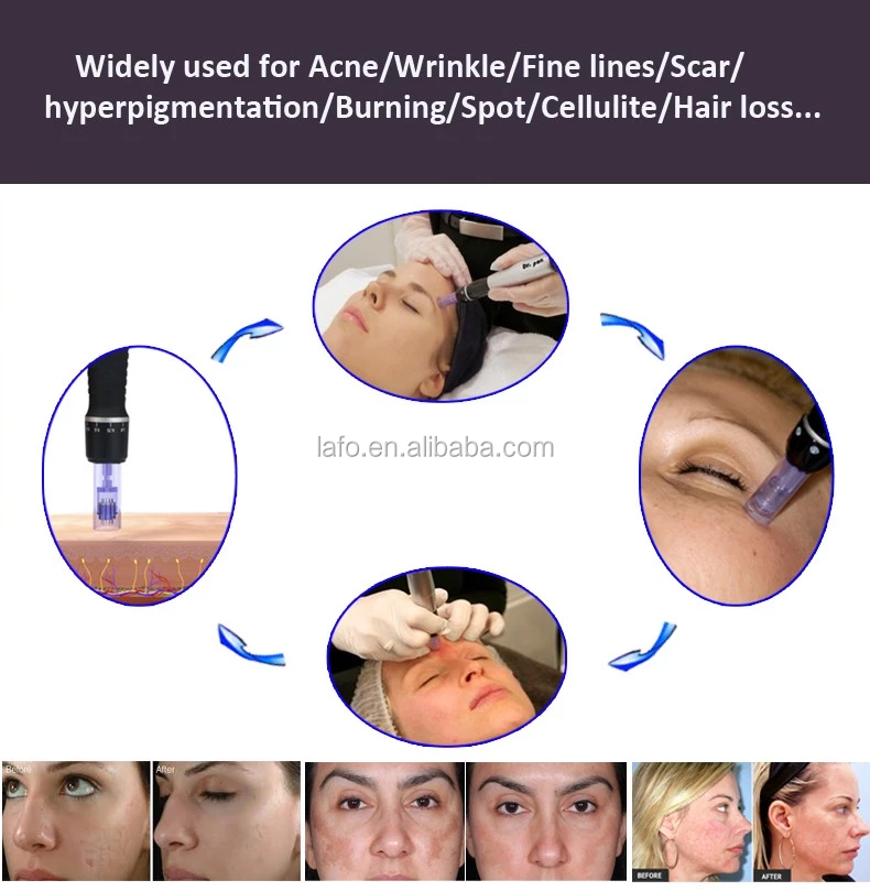 Rechargeable Microneedling dr pen derma roller pen ultima A1 microneedle