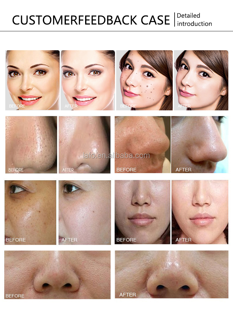 12 in 1 Beauty Spa Use Skin Rejuvenation Hyperbaric oxygen therapy facial machine CE approved LF-826B