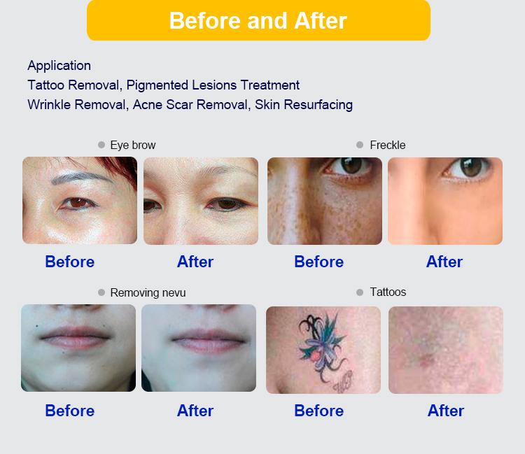 Professional Picosecond Laser Machine Picolaser pigmentation Treatment Freckle Removal 755nm Pico Laser Machine on Sale