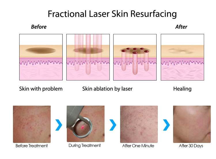 Co2 fractional Laser Hyper Fractionated Vaginal Tightening Skin Resurfacing fractional co2 laser Machine