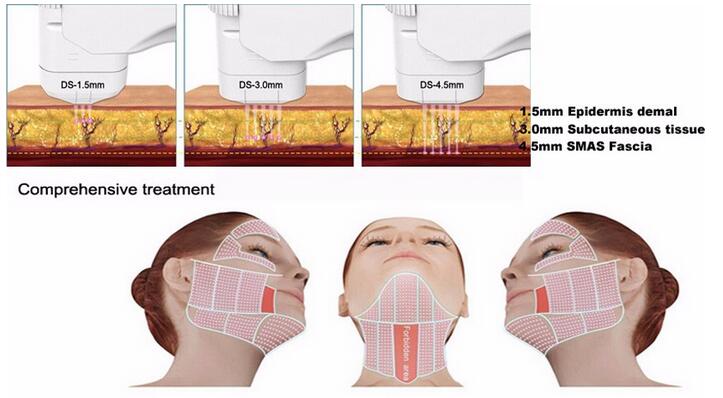 AURO 2 In 1 HIFU Slimming Machine Facial Vaginal Rejuvenation Machine