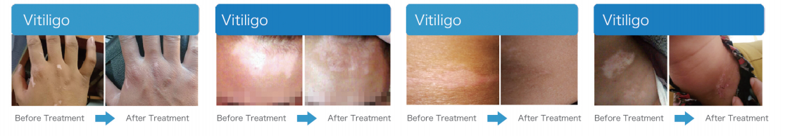 Fototerapia dirigida con excímero de 308 nm, fototerapia UV para el tratamiento de vitiligo y psoriasis