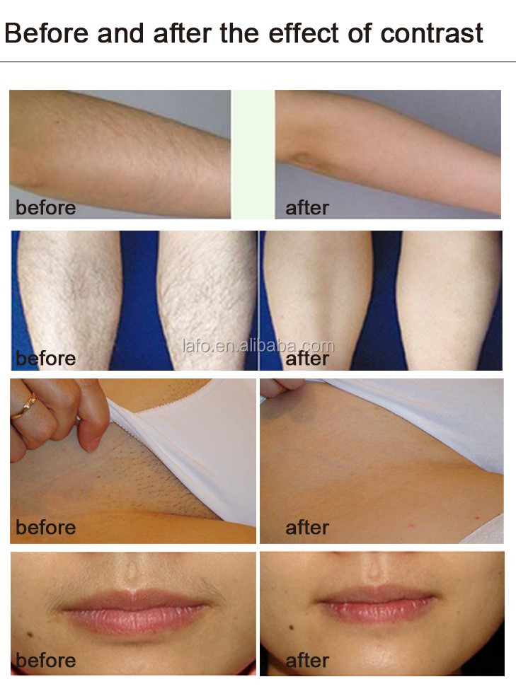 NEW design! 4 in 1 opt IPL+ 808nm diode laser + rf +nd yag laser beauty salon equipment ipl laser hair removal machine