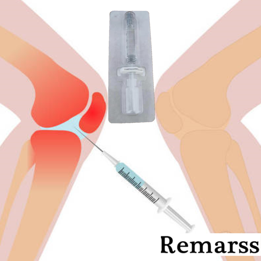 Укол в коленный сустав гиалуроновой. Уколы в колено для суставов гиалуроновая кислота.