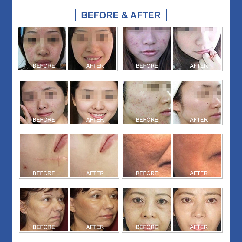 3 years warranty Fractional RF microneedle  SRF + cryo facial machine face liftging machine