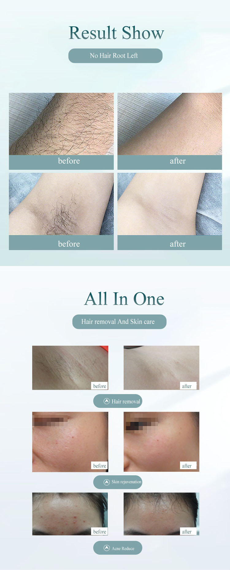 Body Usb Charge Laser Luz Intensa Pulsada Skin Hair Removal Removel Depiladora Electrica Flash And Ipl