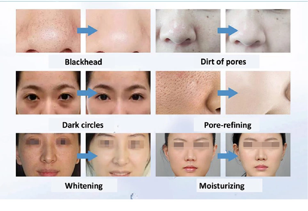 Hydra Beauty Smart Ice Blue 7 in 1 RF Ion Bubble Pen Dermabrasion Skin Analysis Scrubber Water Oxygen Facal Manage Salon Machine