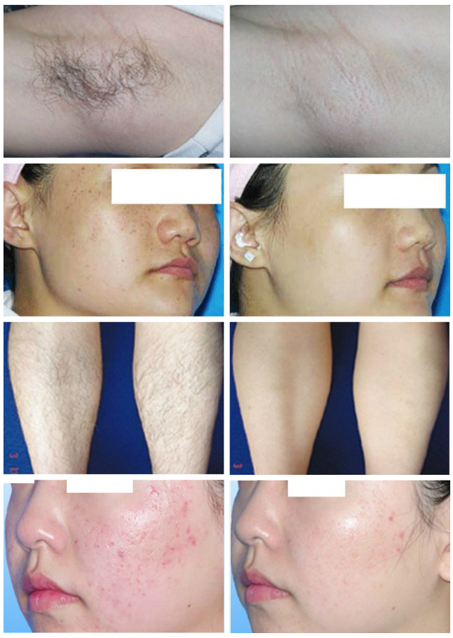 2 合 1 便携式多功能 ipl shr 808 810nm 二极管冰激光脱毛机