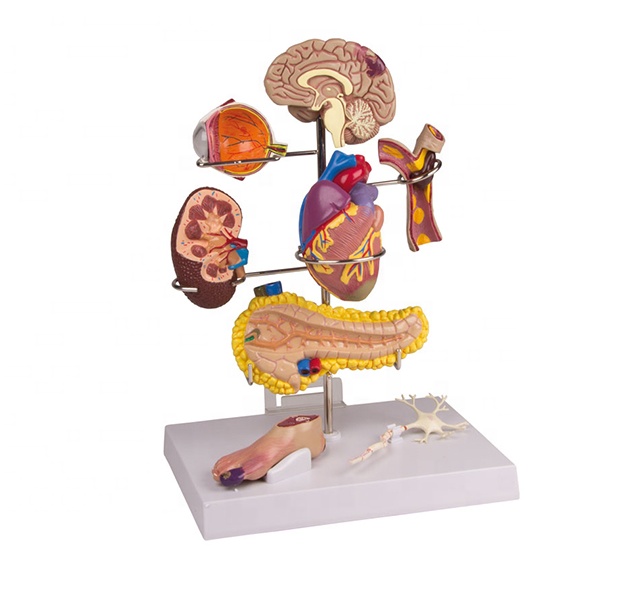 Устройство для измерения гипертонии человека, модель конструкции