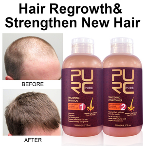 Hair Loss Hair Loss Suppliers And Manufacturers At Alibaba Com