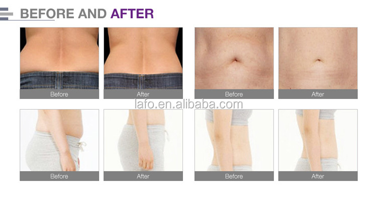 Welight loss 10 pads 650nm Professional Lipo Laser / Lipolaser Slimming Machines for sale LF-313