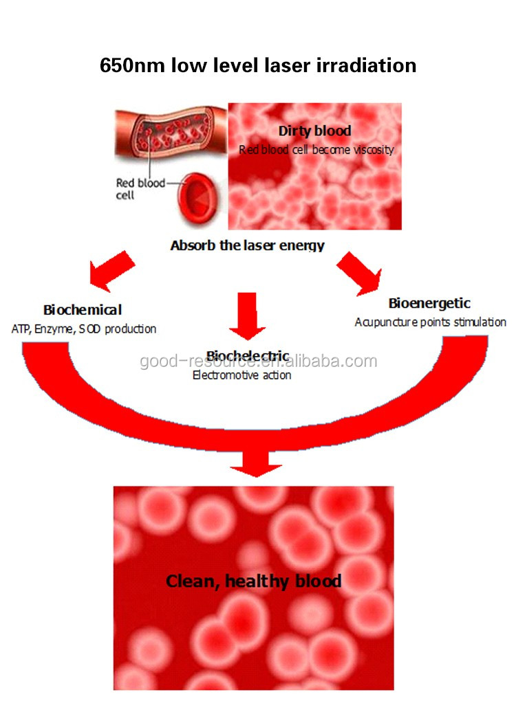 lllt低电平冷激光光疗腕表器缓解鼻炎高血压 - buy nasal sinusitis