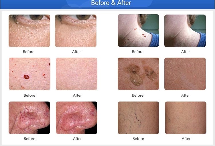 30MHZ high frequency laser spider vein removal/ vascular removal machine laser treatment