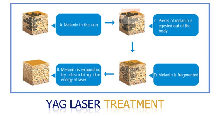 Beijing KES portable laser tattoo removal machine MED-810