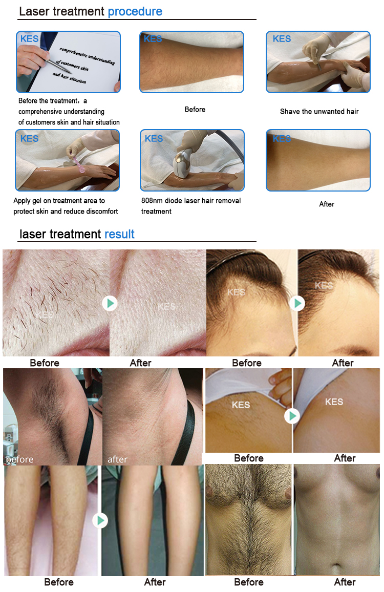 KES Beijing diode laser hair removal cooling system alexandrite lazer hair removal machine med 808