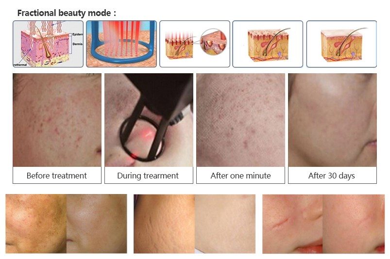 40w korea stretch marks remove vaginal tightening face acne scar treatment fractional co2 fraccionado laser skin machine