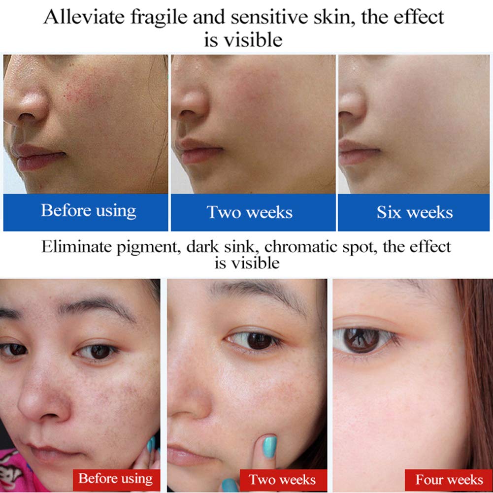 Private Label EGF Anti-Acne Essence Lyophilized Powder Anti-wrinkle Elimination Acne Pit Skin Repair Essence