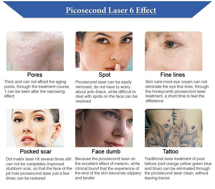 0.7-0.8mm Picosecond Laser Tattoo Removal Machine Nd Yag Hydrodermabrasion