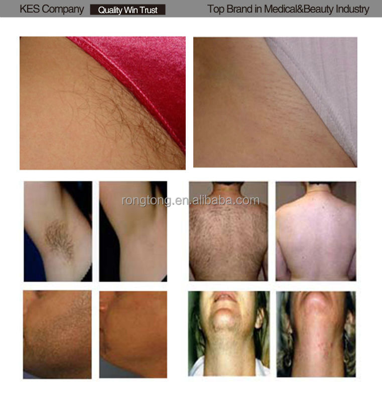 Med-100 portable German Lamp Portable shr IPL hair removal Device