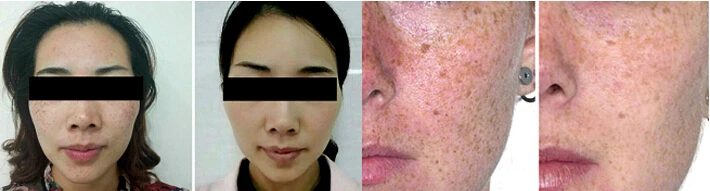 q switch nd yag laser equipment nd yag equipment laser treatment for pigmentation