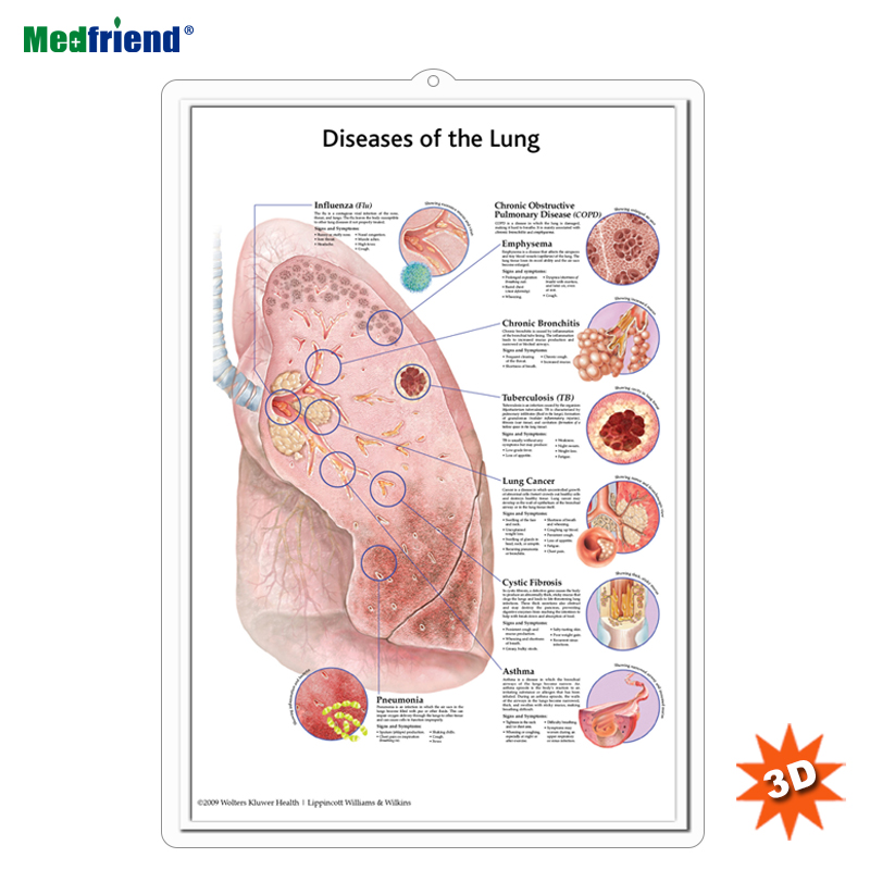 Лицензионная образовательная пластиковая 3D медицинская анатомическая настенная диаграмма/плакат-болезни легких