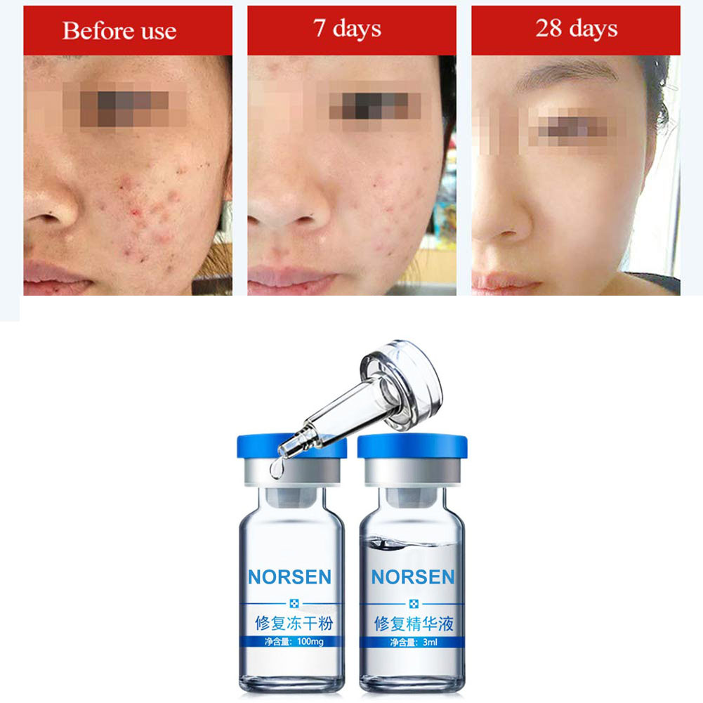 Private Label EGF Anti-Acne Essence Lyophilized Powder Anti-wrinkle Elimination Acne Pit Skin Repair Essence