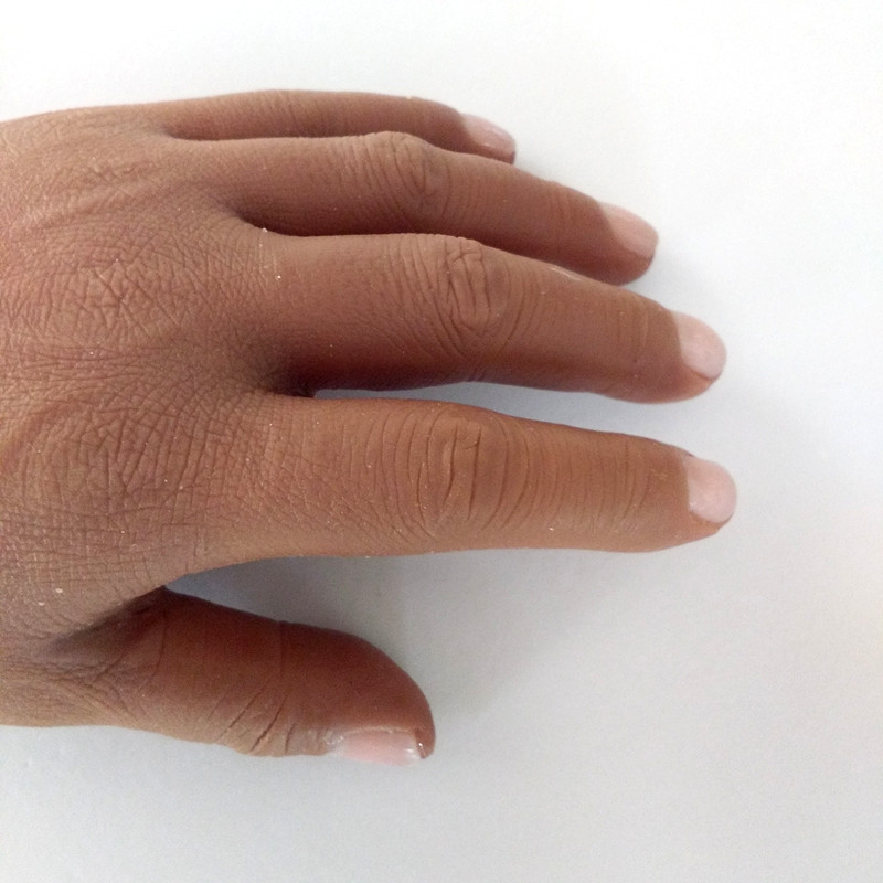 косметические протезы пальцев рук. косметический протез пальца руки. косметический протез кисти. косметические пальцев рук. протез на фалангу большого пальца на руке.