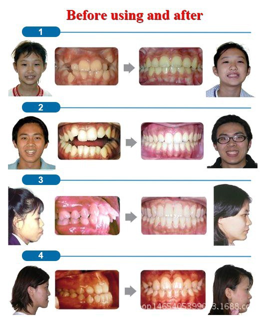 Best Selling OEM T4A teeth orthodontic trainer For Kids T4K