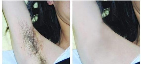 Permanent hair removal machine ipl opt shr factory direct selling
