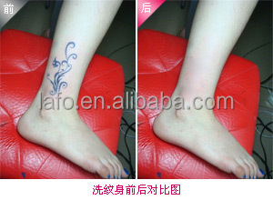 High quality picosecond laser tattoo machine/755nm pico laser tattoo removal equipment LF-686