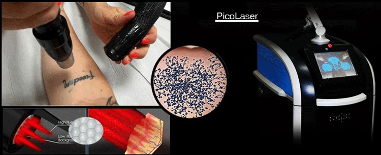 Advanced Nd Yag Laser Tattoo Removal Machine 532nm 1064nm Q Switch Nd Yag Laser Machine